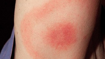 Լայմի հիվանդություն՝ ինչպես խուսափել