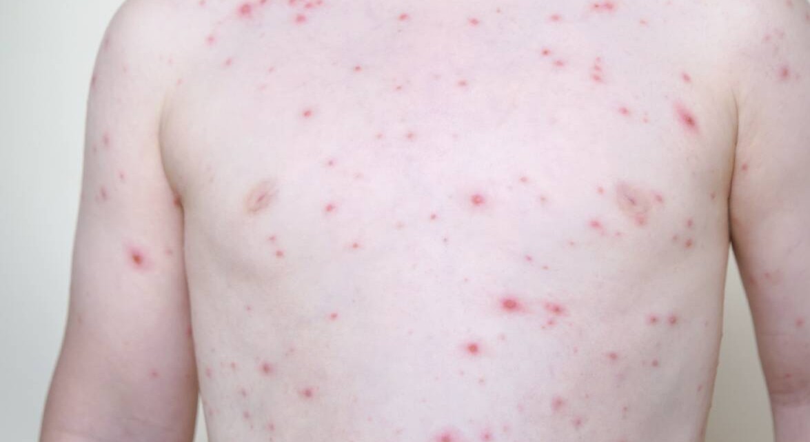 Ջրծաղիկ․ ինչպես տարբերել ցանը, ովքեր են ռիսկի խմբում