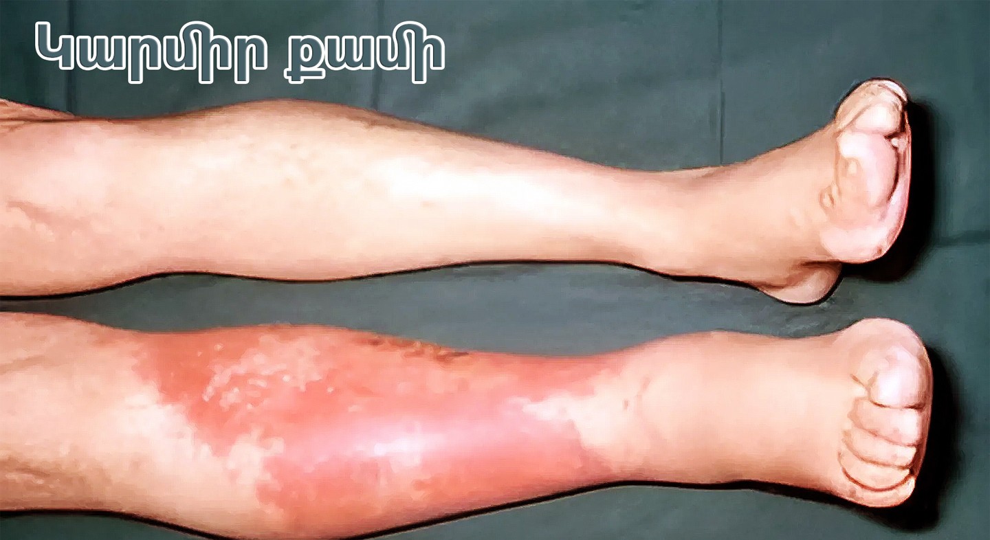 Կարմիր քամի. որոնք են ախտանշանները, ովքեր են ռիսկի խմբում